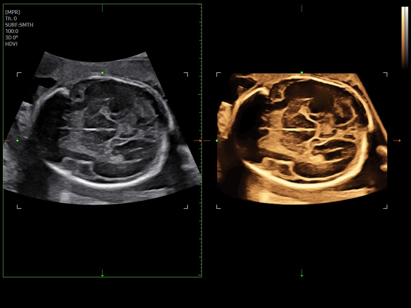 Fetal brain, Slice A (echogramm №943)