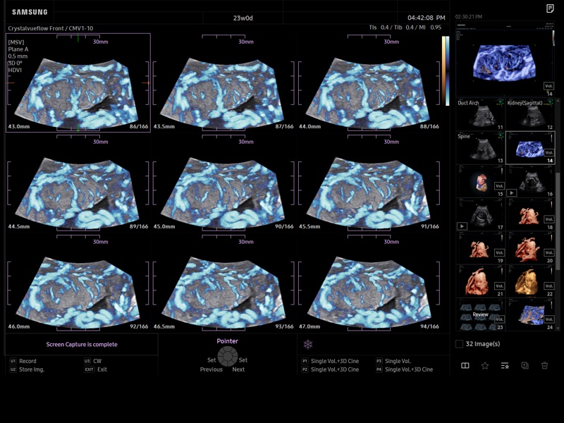 Placenta, MSV & MV-Flow (echogramm №944)