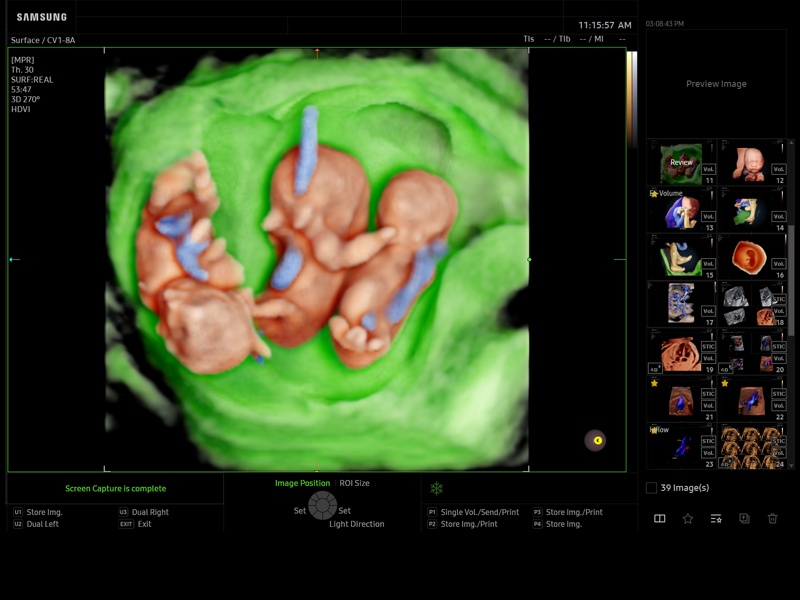 Multiple pregnancy - triplets, EzVolume (echogramm №945)