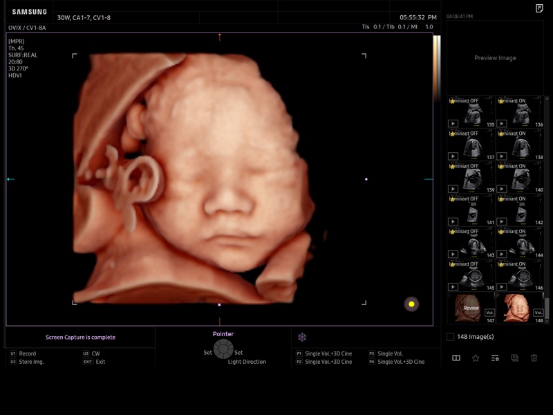 Fetal face, RealisticVue, 3D (echogramm №946)