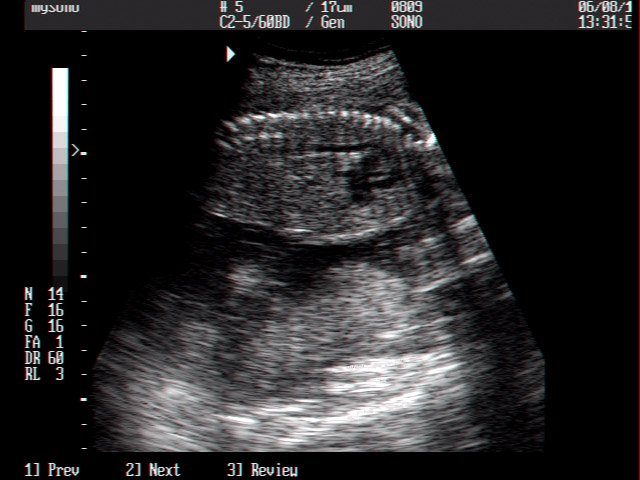 Fetal heart, B-mode (echogramm №10)