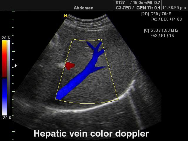 Hepatic vein, color doppler (echogramm №100)