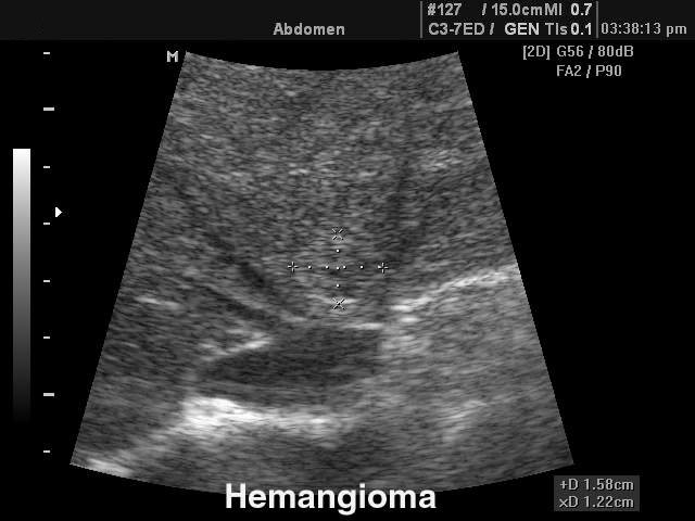 Liver hemangioma, B-mode (echogramm №101)