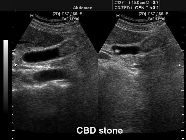Gallbladder stone, B-mode (echogramm №102)