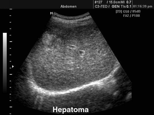 Hepatoma, B-mode (echogramm №103)