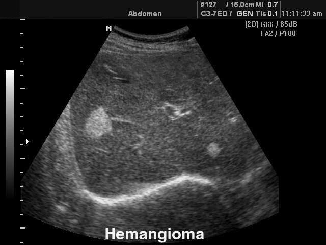 Liver hemangioma, B-mode (echogramm №104)