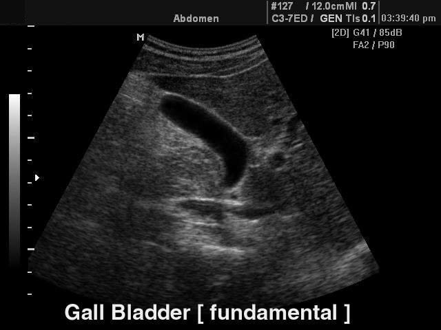 Gall bladder (fundamental harmonic), B-mode (echogramm №105)