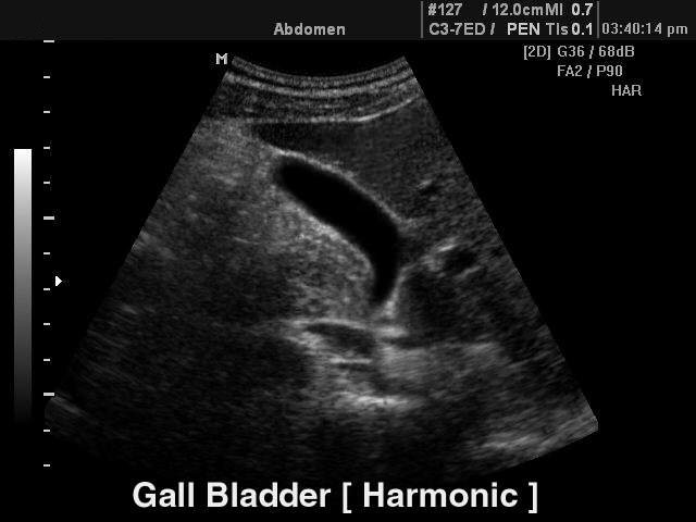 Gall bladder - tissue harmonic, B-mode (echogramm №106)