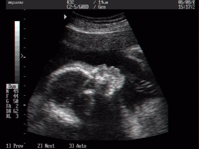 Fetal head, B-mode (echogramm №11)