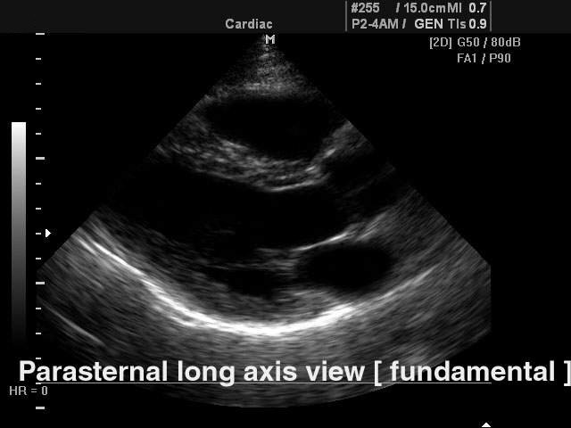 Heart (long axis of LV) - fundamental harmonic, B-mode (echogramm №110)