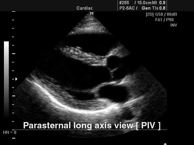 Heart (long axis of LV) - inverse harmonic, B-mode (echogramm №111)