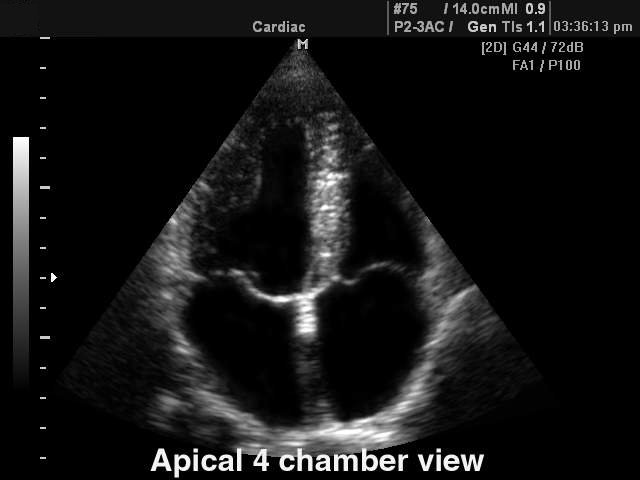 Heart (4 chamber view), B-mode (echogramm №112)
