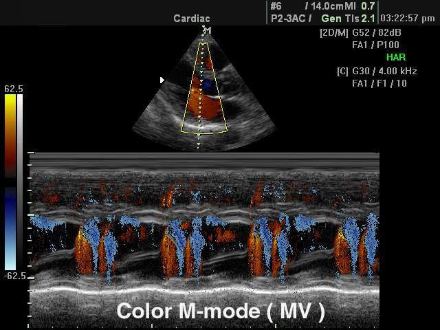 Mitral valve, color M-mode (echogramm №114)