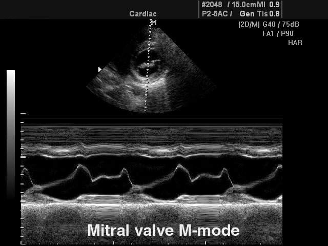Mitral valve, M-mode (echogramm №115)