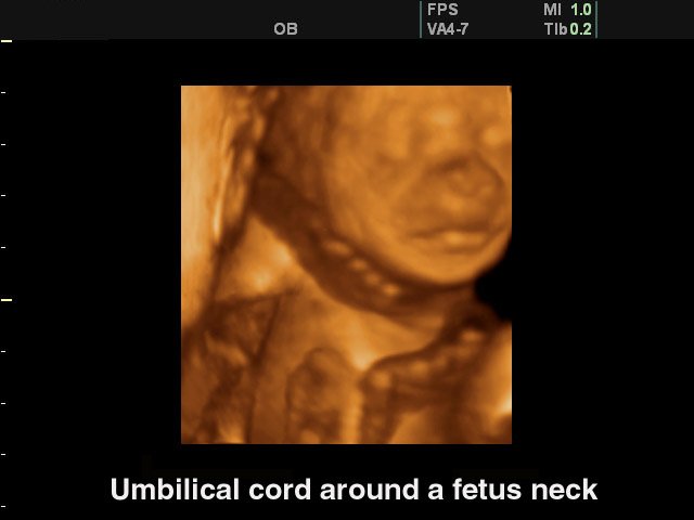Umbilitical cord around a fetus neck, 3D (echogramm №116)