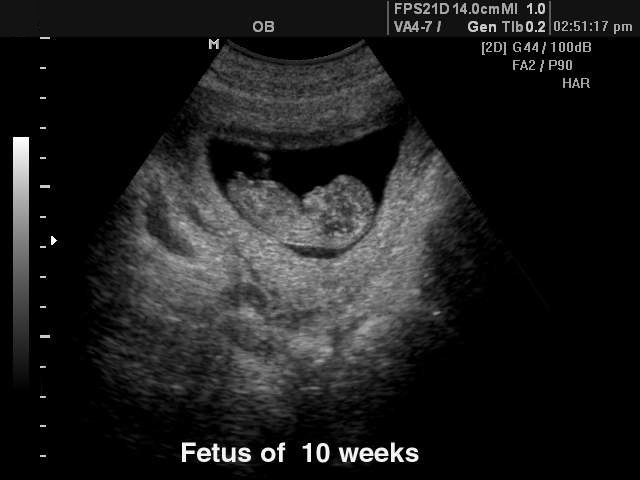 Fetus  - 10 weeks, B-mode (echogramm №118)