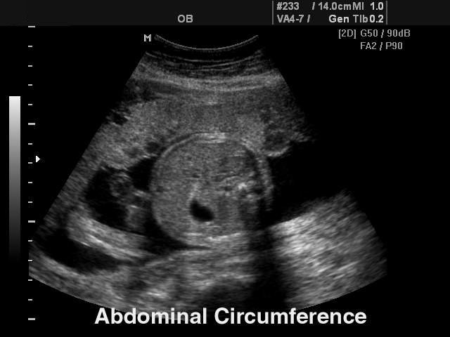 Fetus - abdominal circumference, B-mode (echogramm №120)