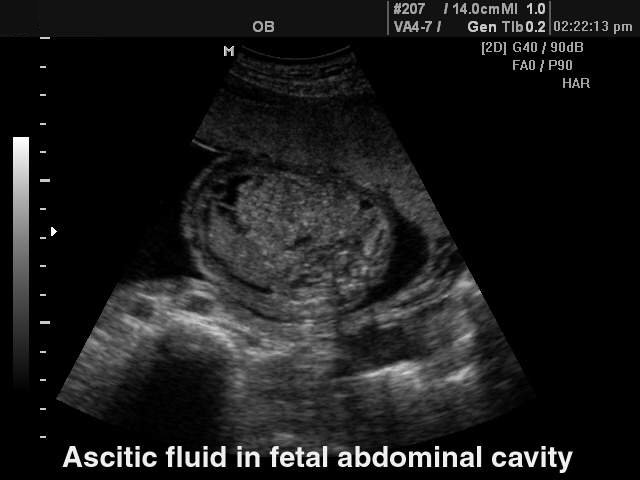 Fetal abdomen ascites, B-mode. (echogramm №121)