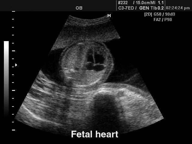 Fetal heart, B-mode (echogramm №122)