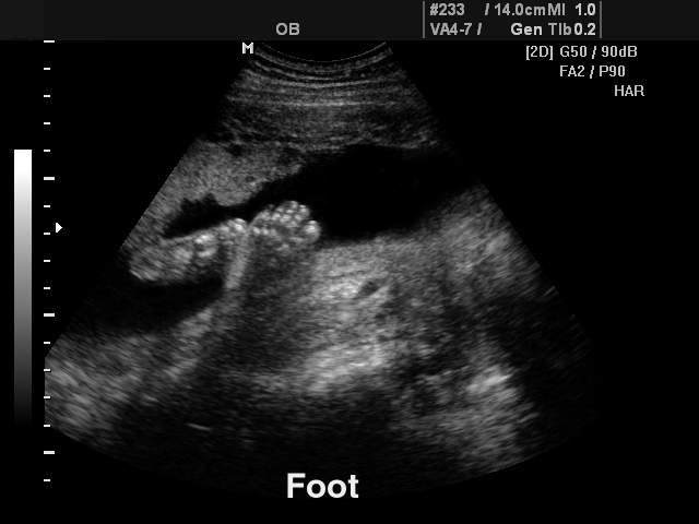 Fetal foot, B-mode (echogramm №123)