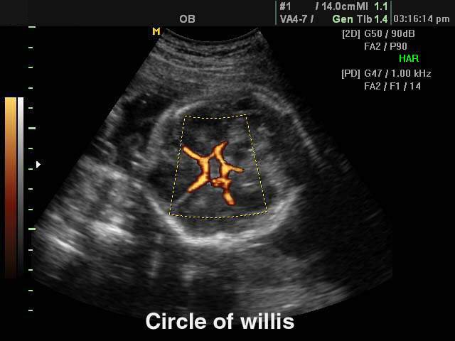 Circle of Willis, power doppler (echogramm №125)