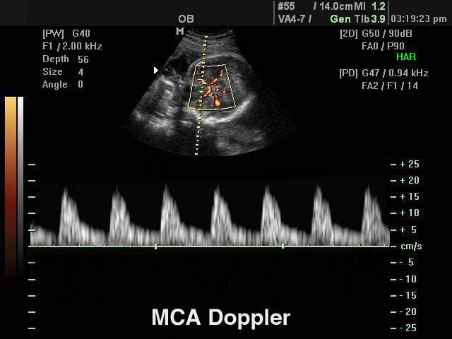 Fetal middle cerebral artery, PD & PW (echogramm №126)