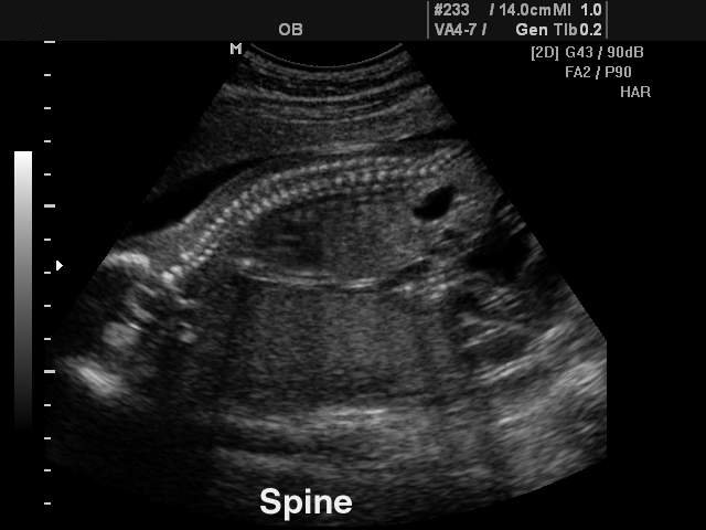 Fetal spine, B-mode (echogramm №127)