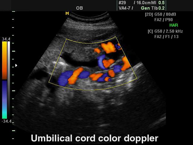 Umbilical cord, сolor doppler (echogramm №128)