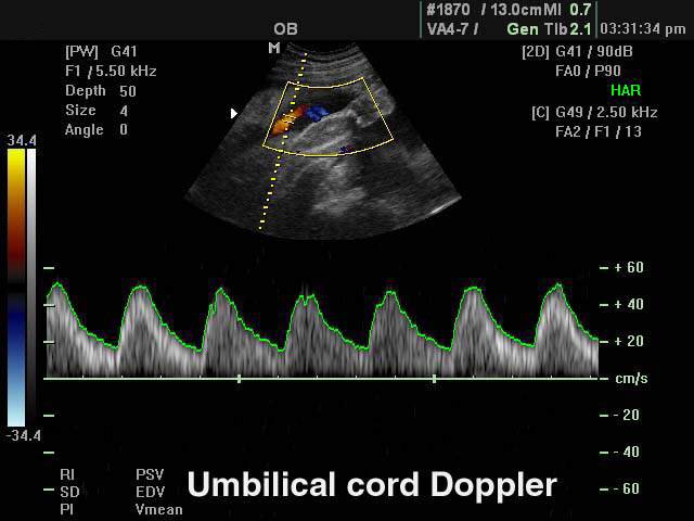 Umbilical cord, CFM & PW (echogramm №129)