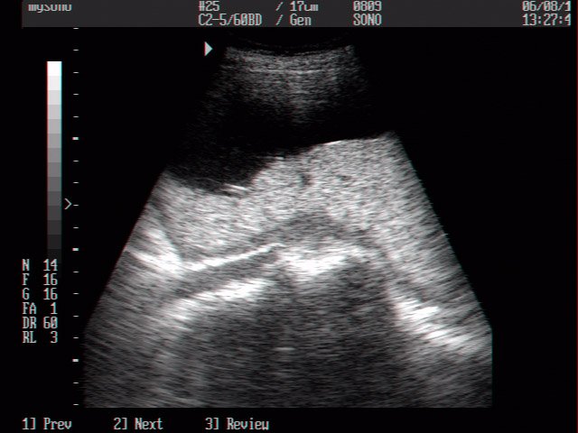 Placenta, B-mode (echogramm №13)