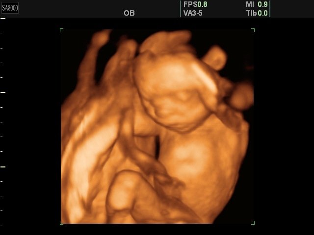 Fetus - 20 weeks, 3D (echogramm №131)