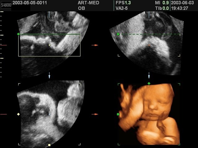 Fetus, 3D (echogramm №132)