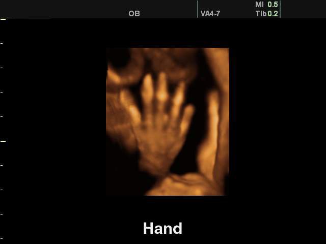 Fetal hand, 3D (echogramm №133)