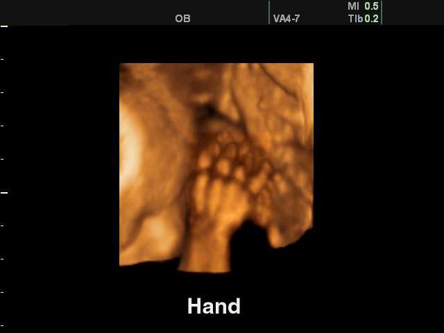 Fetal hand, 3D (echogramm №134)