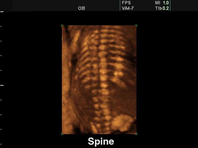 Fetal spine, 3D (echogramm №135)