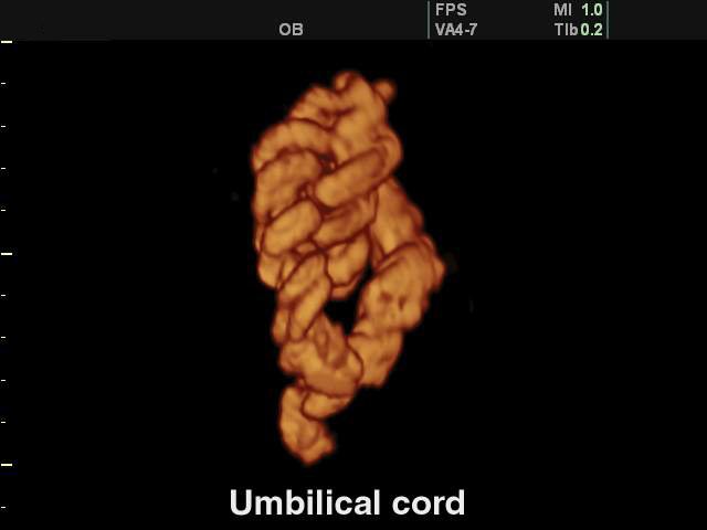 Umbilical cord, 3D (echogramm №136)