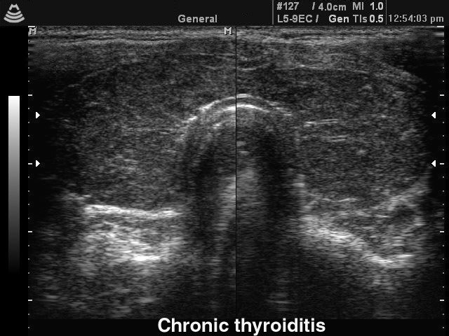 Chronic thyroiditis, B-mode (echogramm №137)