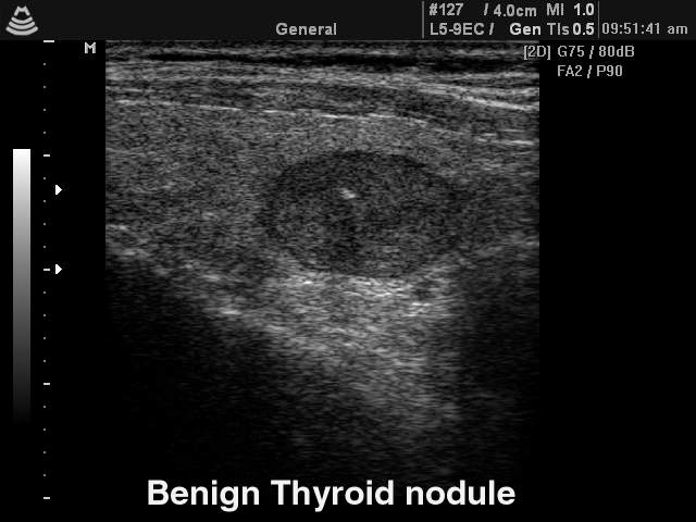 Thyroid benign nodule, B-mode (echogramm №139)