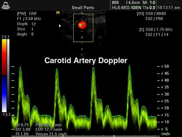 Common carotid artery, CFM & PW (echogramm №143)