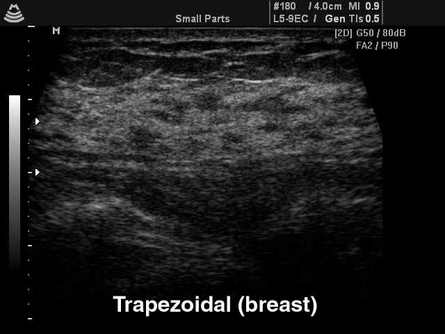 Breast, trapezoidal B-mode (echogramm №145)