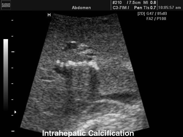 Intrahepatic calcification, B-mode (echogramm №146)