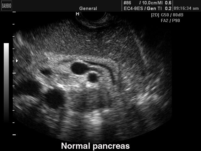 Pancreas - norm, B-mode (echogramm №147)