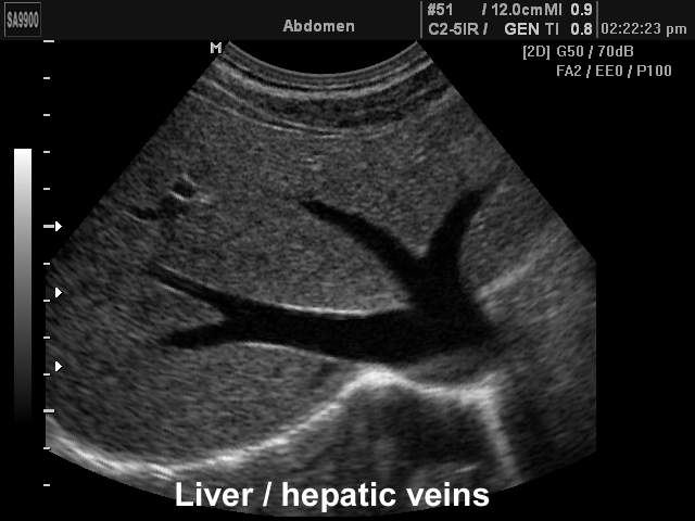 Liver and hepatic veins, B-mode (echogramm №149)