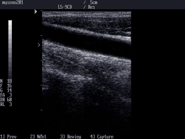 Common carotid artery, B-mode (echogramm №15)