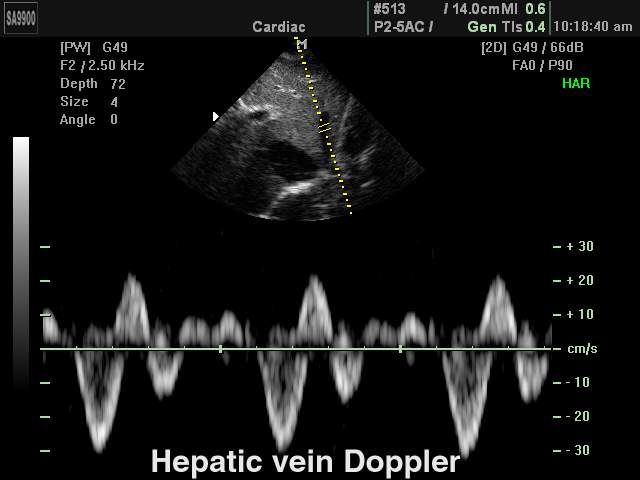 Hepatic vein, PW (echogramm №151)