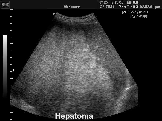 Liver - hepatoma, B-mode (echogramm №154)