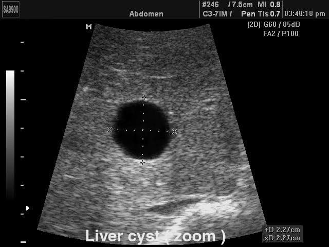 Liver cyst, B-mode (echogramm №159)