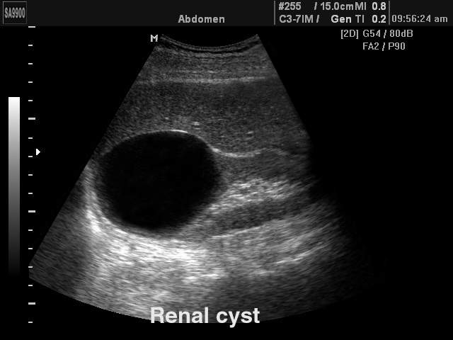 Renal cyst, B-mode (echogramm №163)