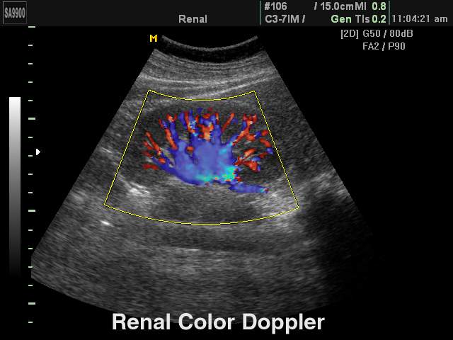 Kidney, color doppler (echogramm №165)