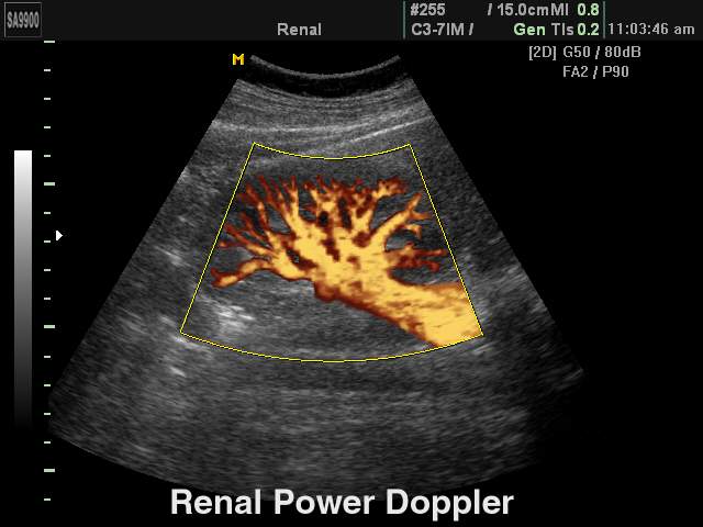 Kidney, power doppler (echogramm №166)